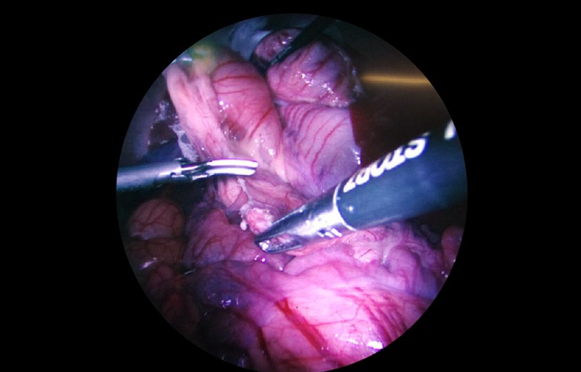 Endoscopio
