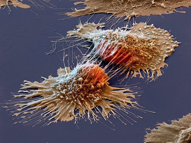 Celulas de cáncer.