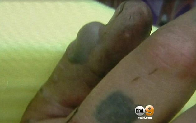 Así quedó la mano de Álex Gómez tras el mordisco.