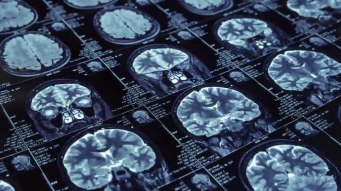Escaneo del cerebro.