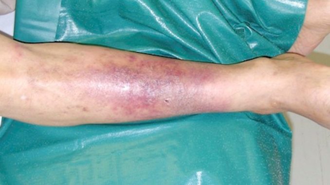 Necrosis de una pierna por la bacteria