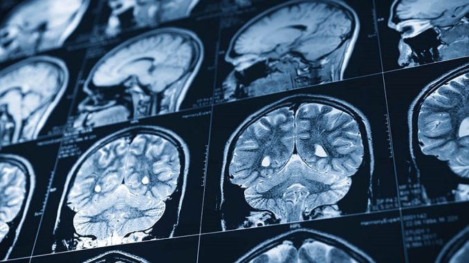 Placas de una persona afectada por un accidente cerebrovascular