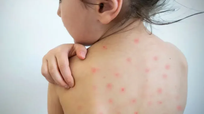 El sarampión ataca sobre todo a los niños