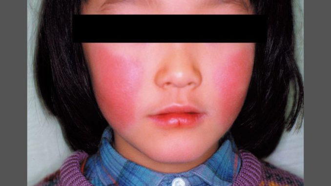 Eritema infeccioso (Instituto de Enfermedades Infecciosas de Japón)